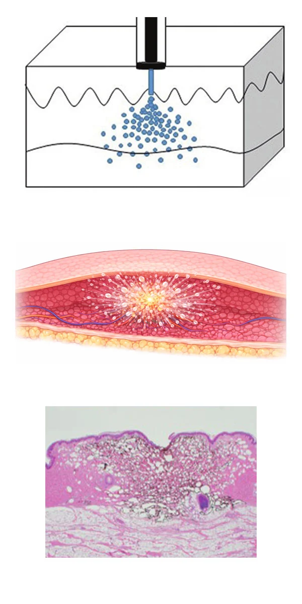Needlefree acne scar subcision