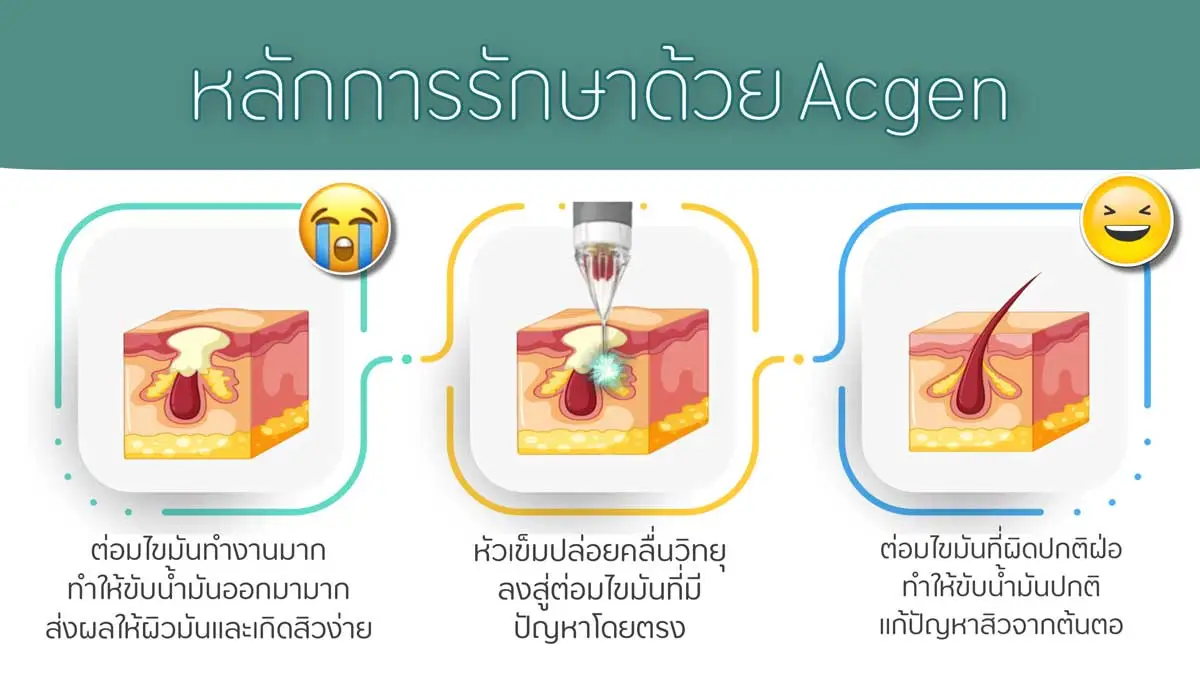 Acgen รักษาสิว หลักการ
