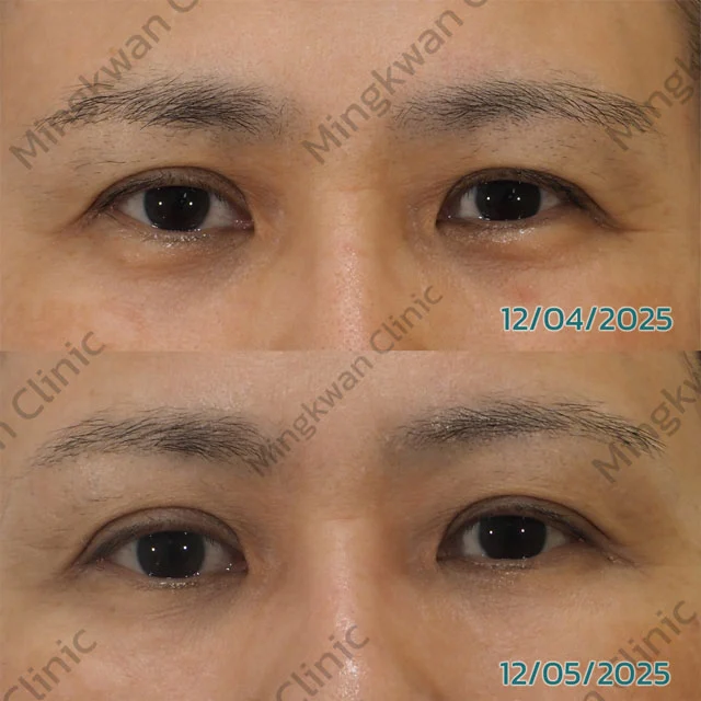 รีวิว Endolift X ถุงใต้ตา 2