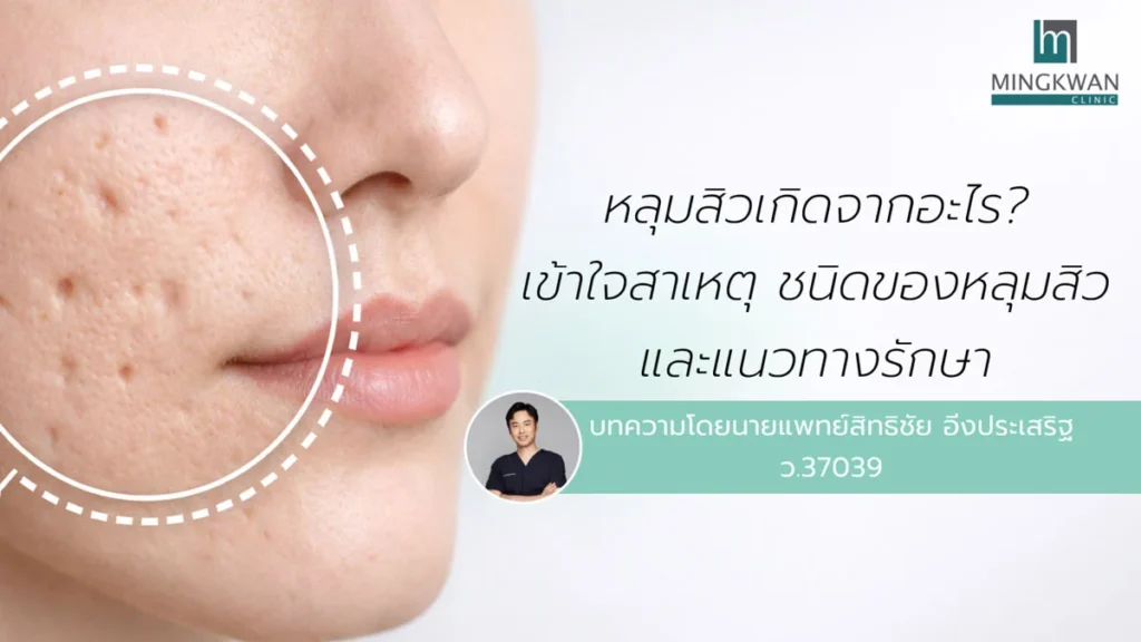 หลุมสิวเกิดจากอะไร? สาเหตุ ชนิดของหลุมสิว และวิธีการรักษาหลุมสิว