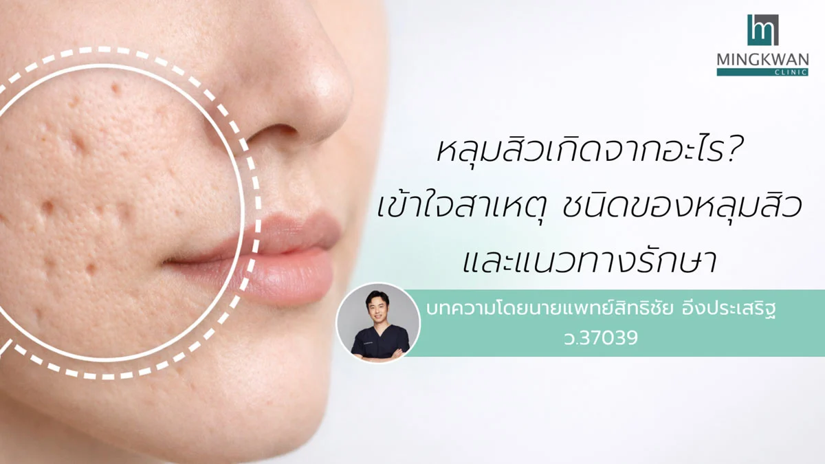 รักษาสิว ไม่กินยา