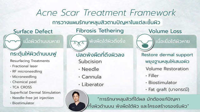 วิธีรักษา ผสมผสาน หลุมสิว