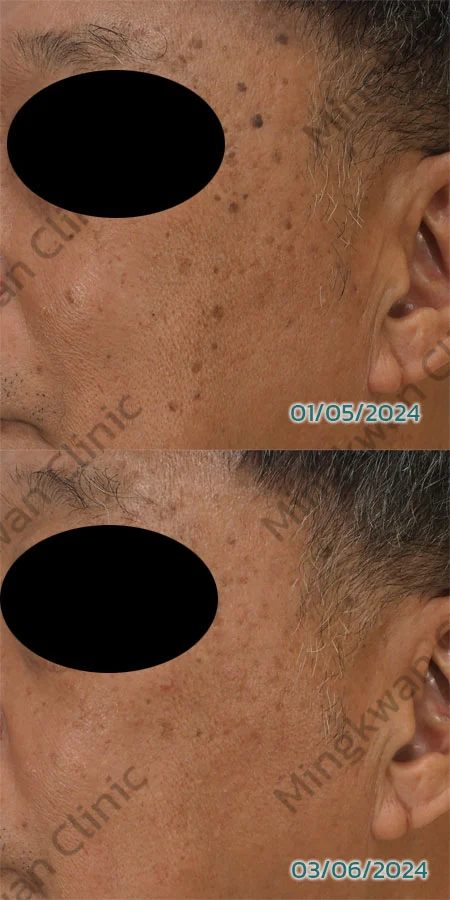 Seborrheic Keratosis Skin Tag Removal before after