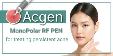 Acgen Acne Treatment