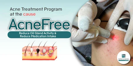 Acnefree 1450 Acne Treatment