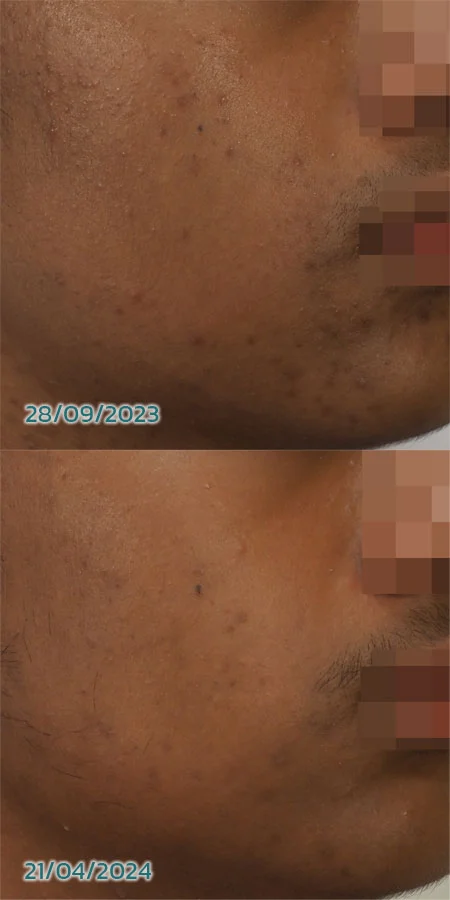 Acne laser 1450 nm before after
