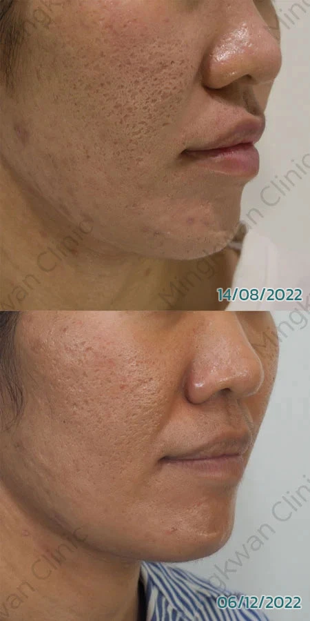 Acne Scar Treatment Review 2