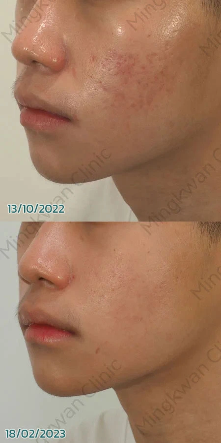 Fractional CO2 Laser Results