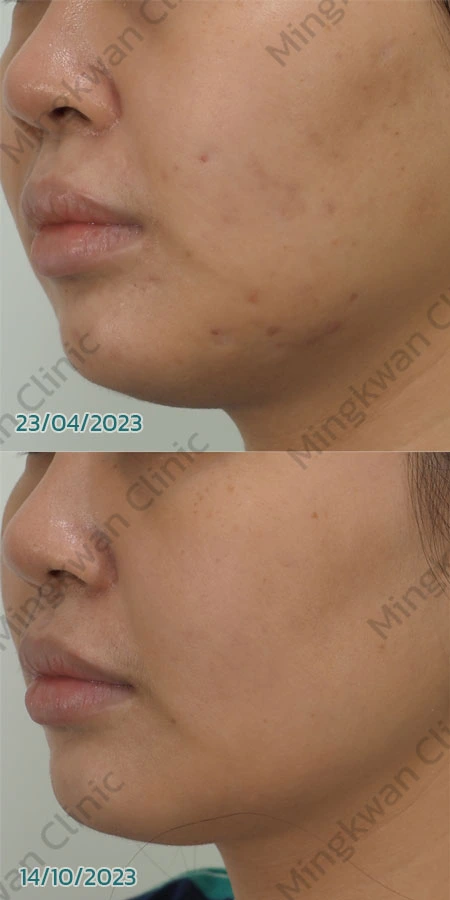 Acne Scar Treatment Review 4