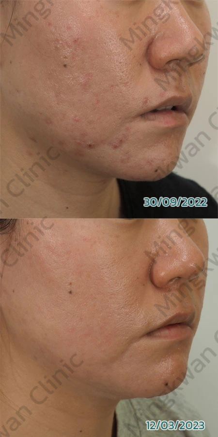 Acne Scar Treatment Review 5