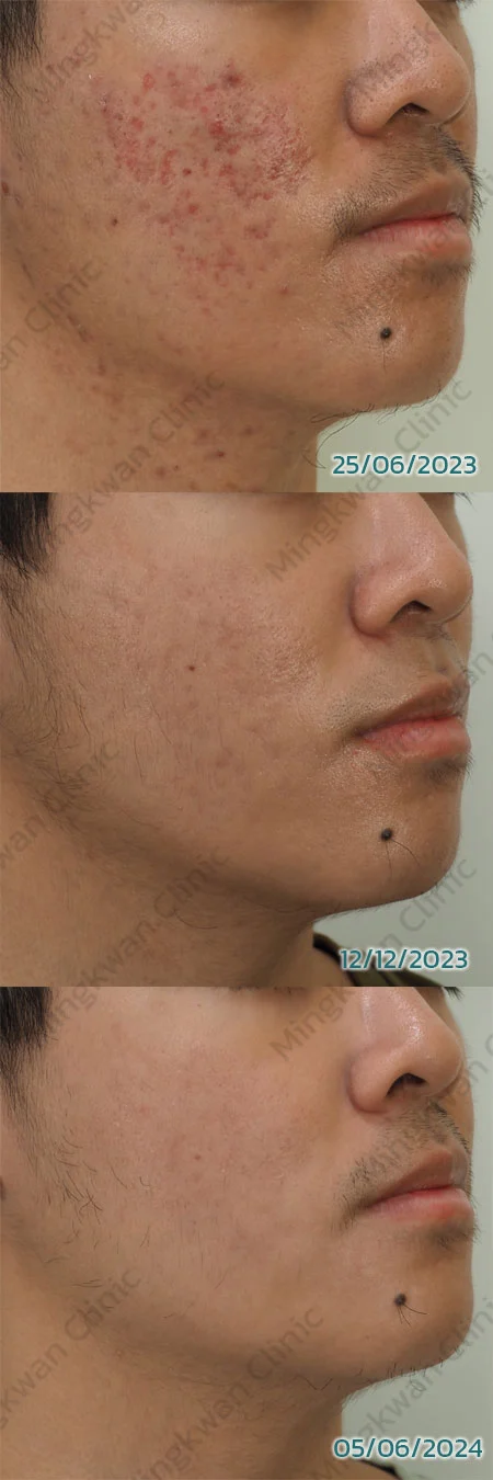 Acne Scar Treatment Review 1