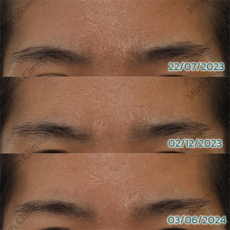 Acne Scar Treatment Fractional CO2 and Picosecond Laser