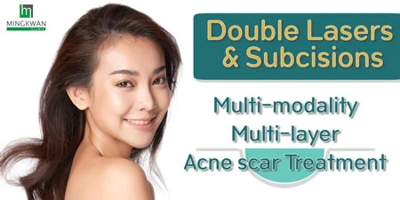 Acne Scar Treatment Double Lasers and Subcisions