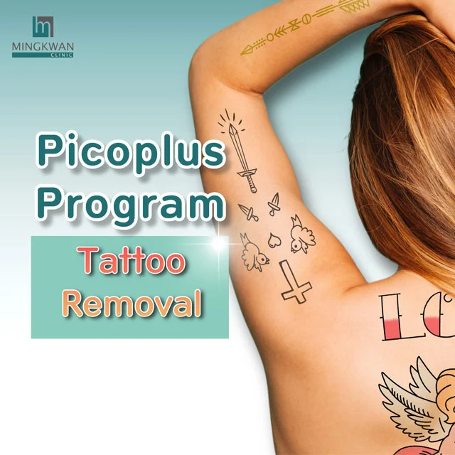 Picosecond Laser Tattoo Removal