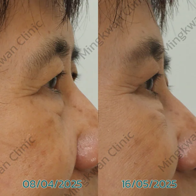 Endolift X Review Under eye bags 1