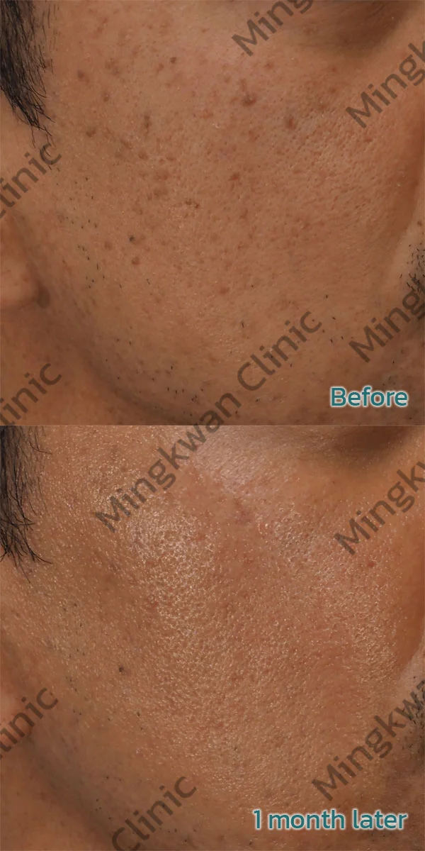 Seborrheic Keratosis Removal before after